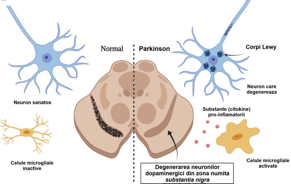 parkinson