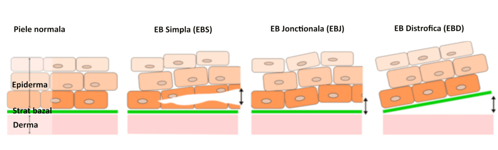 epidermoliza buloasa