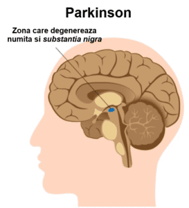 parkinson zona care degenereaza