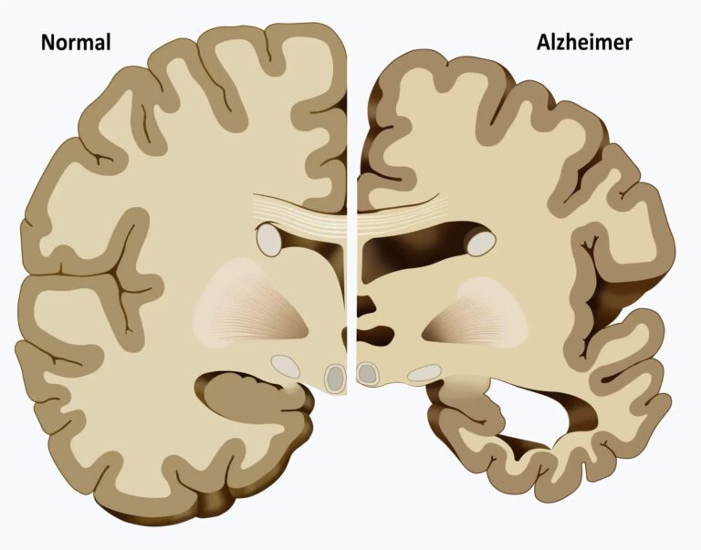 alzheimer