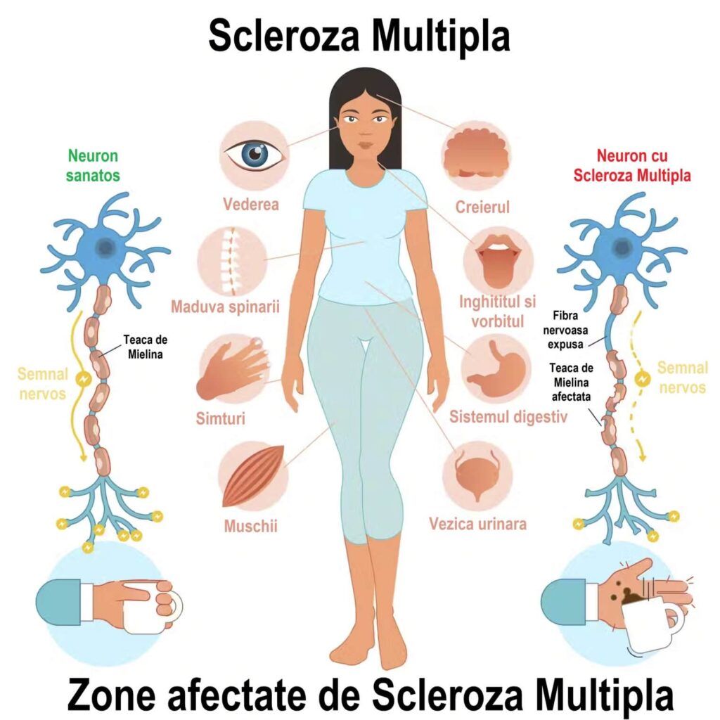 simptome scleroza multipla