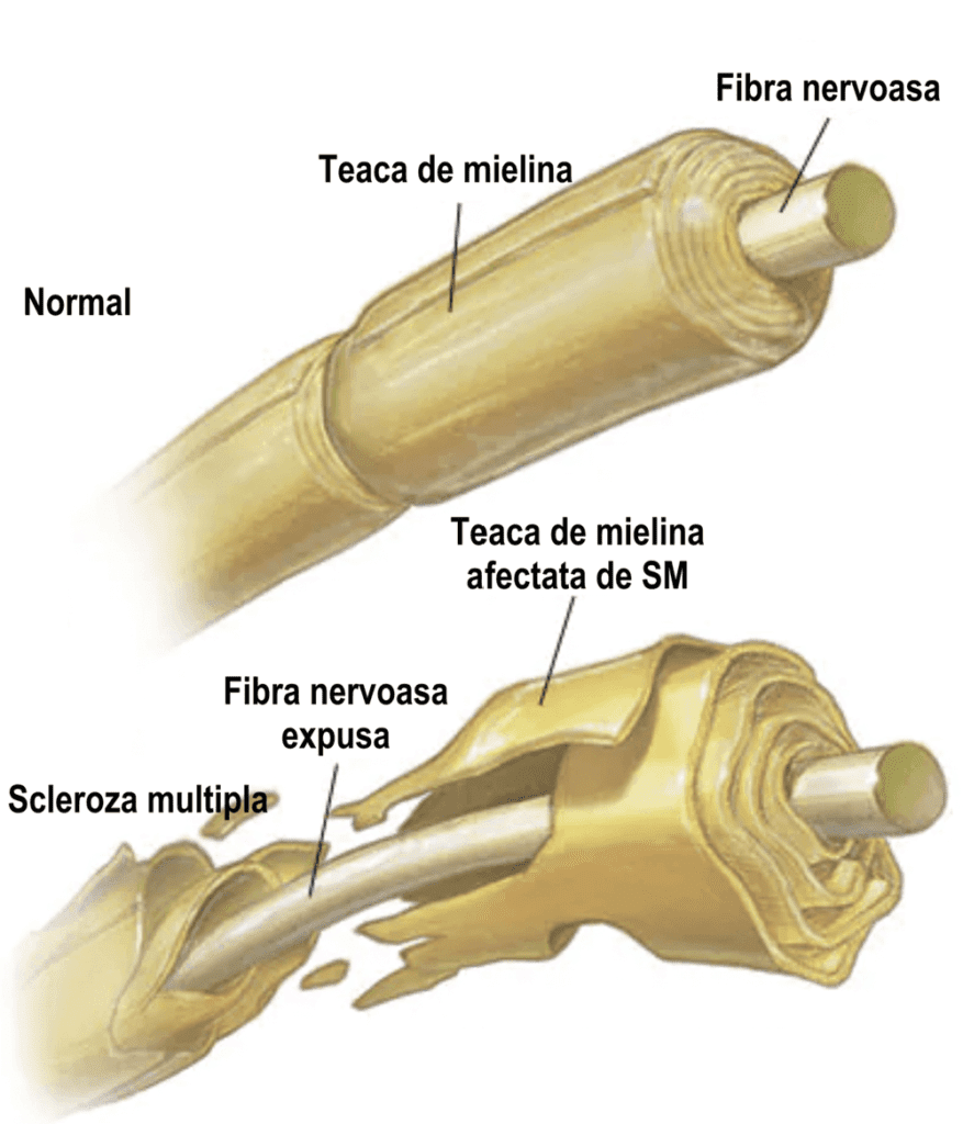 scleroza multipla